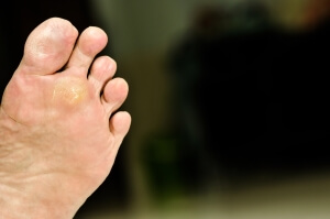 Where Do Plantar Warts Develop?