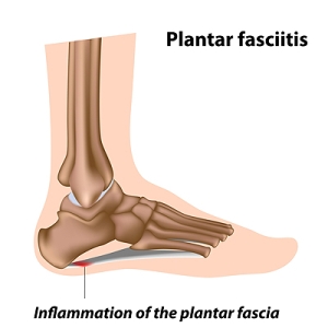 Where Is the Plantar Fascia?
