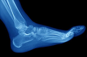 What Causes Arch Pain?