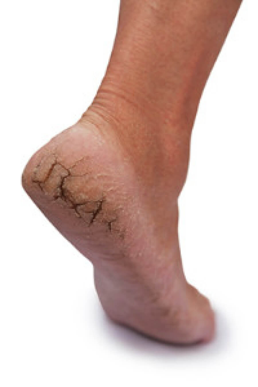 Understanding Cracked Heels: Causes | Scholl UK