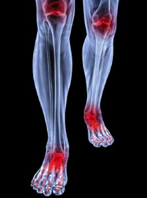 Can Arthritis Affect the Feet?